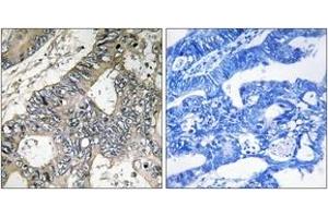 Immunohistochemistry analysis of paraffin-embedded human colon carcinoma tissue, using GUF1 Antibody. (GUF1 antibody  (AA 421-470))
