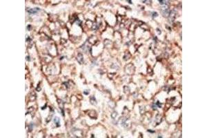 IHC analysis of FFPE human hepatocarcinoma tissue stained with the BMPR1A antibody (BMPR1A antibody  (AA 166-196))