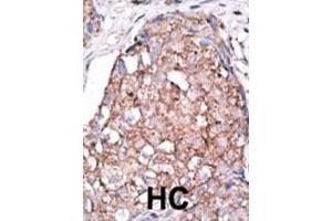 Formalin-fixed and paraffin-embedded human cancer tissue reacted with the primary antibody, which was peroxidase-conjugated to the secondary antibody, followed by AEC staining. (SIGLEC7 antibody  (C-Term))