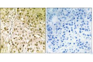 Peptide - +Immunohistochemistry analysis of paraffin-embedded human breast carcinoma tissue, using DNA Polymerase θ antibody. (POLQ antibody  (Internal Region))