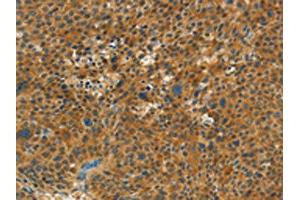 The image on the left is immunohistochemistry of paraffin-embedded Human liver cancer tissue using ABIN7191682(NPAP1 Antibody) at dilution 1/60, on the right is treated with synthetic peptide. (NPAP1 antibody)