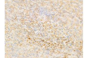ABIN6255593 and ABIN6267543 at 1/100 staining human hepatocellular carcinoma by IHC-P. (Tuberin antibody  (pThr1462))