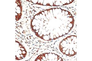 Immunohistochemistry of paraffin-embedded human colon carcinoma using Cytokeratin 13 (Cytokeratin 13 (KRT13)) antibody (ABIN7268090) at dilution of 1:100 (40x lens). (Cytokeratin 13 antibody  (AA 269-458))