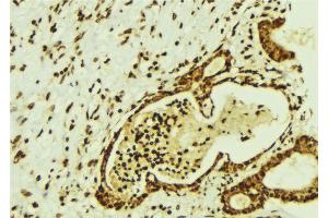 ABIN6274350 at 1/100 staining Human breast cancer tissue by IHC-P. (CBFB antibody  (N-Term))