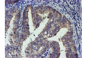 Immunohistochemical staining of paraffin-embedded Adenocarcinoma of Human endometrium tissue using anti-TCP11L2 mouse monoclonal antibody. (TCP11L2 antibody)