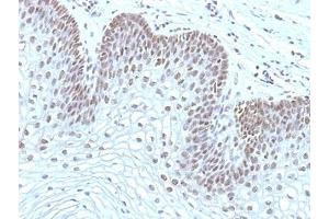 Formalin-fixed, paraffin-embedded human cervical carcinoma stained with MAP3K1 antibody (2F6). (MAP3K1 antibody  (AA 1211-1310))