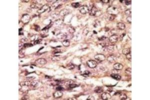 IHC analysis of FFPE human hepatocarcinoma tissue stained with the ATG7 antibody (ATG7 antibody  (AA 494-523))