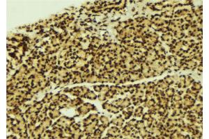ABIN6269272 at 1/100 staining Human breast cancer tissue by IHC-P. (CEBPA antibody  (N-Term))
