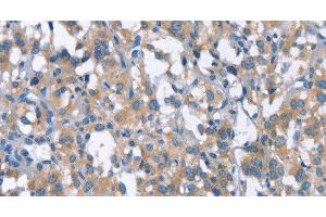 Immunohistochemistry of paraffin-embedded Human thyroid cancer using CDC25A Polyclonal Antibody at dilution of 1:50 (CDC25A antibody)