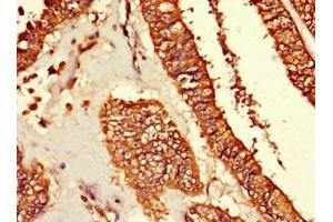 Immunohistochemistry of paraffin-embedded human endometrial cancer using ABIN7173699 at dilution of 1:100 (TUBG1 antibody  (AA 29-184))