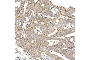 Immunohistochemistry of paraffin-embedded human colon carcinoma using S Rabbit mAb (ABIN7270501) at dilution of 1:250 (40x lens). (SAMM50 antibody)