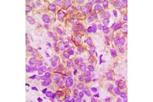Immunohistochemical analysis of Cytochrome P450 2B6 staining in human breast cancer formalin fixed paraffin embedded tissue section. (CYP2B6 antibody  (Center))