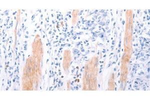 Immunohistochemistry of paraffin-embedded Human gasrtic cancer tissue using LPAR2 Polyclonal Antibody at dilution 1:40 (EDG4 antibody)