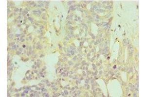 Immunohistochemistry of paraffin-embedded human endommetrial cancer using ABIN7155969 at dilution of 1:100 (HYAL1 antibody  (AA 136-435))