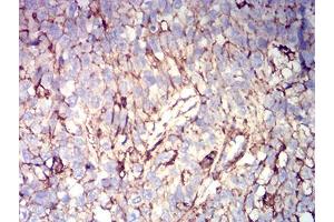 Immunohistochemical analysis of paraffin-embedded bladder cancer tissues using CD44 mouse mAb with DAB staining. (CD44 antibody  (AA 36-194))