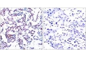 Immunohistochemistry analysis of paraffin-embedded human breast carcinoma, using JunB (Phospho-Ser259) Antibody. (JunB antibody  (pSer259))