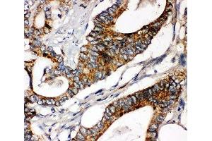 IHC-P: Laminin gamma 1 antibody testing of human intestinal cancer tissue (Laminin gamma 1 antibody  (AA 1566-1579))