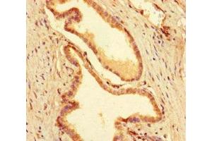 Immunohistochemistry of paraffin-embedded human prostate cancer using ABIN7155782 at dilution of 1:100