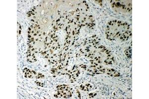 IHC-P: p63 antibody testing of human esophageal squamous cell carcinoma tissue (TCP1 alpha/CCTA antibody  (AA 82-98))