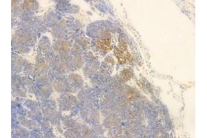 LAT Antibody at 1/100 staining human thymoma by IHC-P.