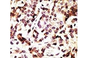 IHC analysis of FFPE human breast carcinoma tissue stained with the Beclin 1 antibody