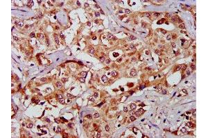 IHC image of ABIN7154482 diluted at 1:1000 and staining in paraffin-embedded human liver cancer performed on a Leica BondTM system.