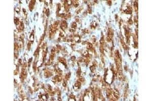 IHC testing of FFPE rhabdomyosarcoma with Muscle Actin antibody (Actin antibody)