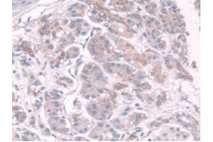 IHC-P analysis of Human Pancreas Cancer Tissue, with DAB staining. (TPMT antibody  (AA 26-227))