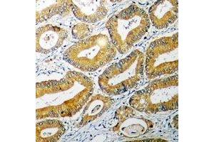 Immunohistochemical analysis of BID staining in human colon cancer formalin fixed paraffin embedded tissue section. (BID antibody)