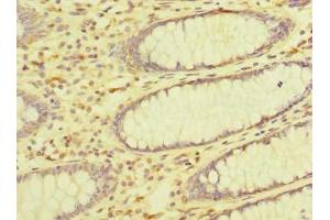 Immunohistochemistry of paraffin-embedded human colon cancer using ABIN7162546 at dilution of 1:100
