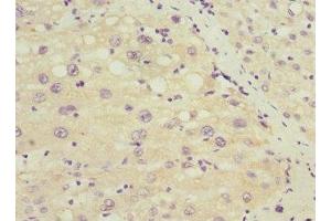 Immunohistochemistry of paraffin-embedded human liver cancer using ABIN7172635 at dilution of 1:100 (SOX5 antibody  (AA 1-120))