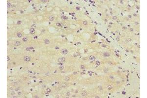 Immunohistochemistry of paraffin-embedded human liver cancer using ABIN7172635 at dilution of 1:100 (SOX5 antibody  (AA 1-120))