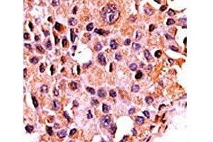 IHC analysis of FFPE human breast carcinoma tissue stained with the Calcineurin antibody (CAN antibody  (AA 21-51))