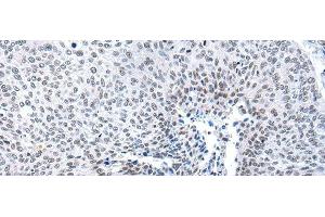 Immunohistochemistry of paraffin-embedded Human lung cancer tissue using MORC2 Polyclonal Antibody at dilution of 1:25(x200) (MORC2 antibody)
