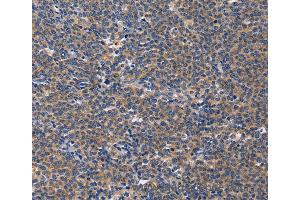 Immunohistochemistry of Human liver cancer using CD5L Polyclonal Antibody at dilution of 1:40