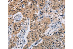Immunohistochemistry of Human lung cancer using TLR3 Polyclonal Antibody at dilution of 1:50 (TLR3 antibody)