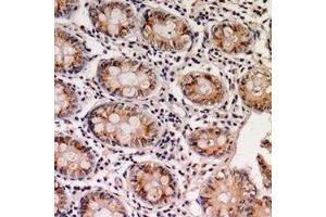 Immunohistochemical analysis of EPS8L1 staining in human colon cancer formalin fixed paraffin embedded tissue section. (EPS8-Like 1 antibody)