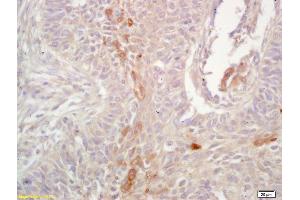 Formalin-fixed and paraffin embedded human lung carcinoma labeled with Rabbit Anti HLA-G Polyclonal Antibody, Unconjugated (ABIN1385132) at 1:200 followed by conjugation to the secondary antibody and DAB staining (HLAG antibody  (AA 281-338))