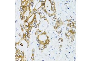 Immunohistochemistry of paraffin-embedded human colon carcinoma using SIRT2 antibody (ABIN3020851, ABIN3020852, ABIN3020853 and ABIN6213756) at dilution of 1:100 (40x lens). (SIRT2 antibody  (AA 288-389))
