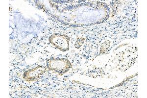 ABIN6259590 and ABIN6275930 at 1/100 staining Human gastric cancer by IHC-P. (BUD31 antibody  (N-Term))
