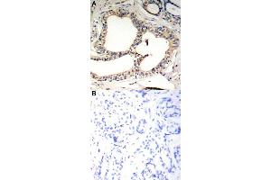 Immunohistochemical staining of human breast cancer tissue by Nfkbie (phospho S22) polyclonal antibody  without blocking peptide (A) or preincubated with blocking peptide (B) under 1:50-1:100 dilution.