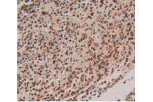 IHC-P analysis of Human Rectum Cancer Tissue, with DAB staining. (S100P antibody  (AA 1-95))