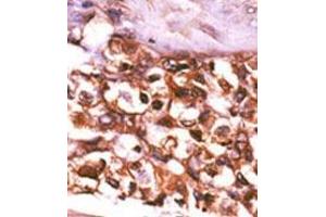 Formalin-fixed and paraffin-embedded human cancer tissue (hepatocarcinoma) reacted with the primary antibody, which was peroxidase-conjugated to the secondary antibody, followed by AEC staining. (Ribokinase antibody  (N-Term))