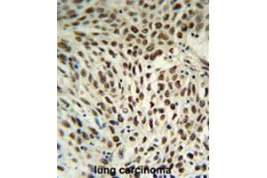 SNRPD3 Antibody (C-term) IHC analysis in formalin fixed and paraffin embedded human lung carcinoma followed by peroxidase conjugation of the secondary antibody and DAB staining. (SNRPD3 antibody  (C-Term))