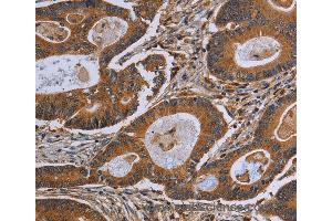 Immunohistochemistry of Human colon cancer using GJB4 Polyclonal Antibody at dilution of 1:40 (GJB4 antibody)