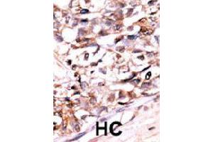 Formalin-fixed and paraffin-embedded human hepatocellular carcinoma tissue reacted with DUSP13 polyclonal antibody  , which was peroxidase-conjugated to the secondary antibody, followed by AEC staining. (DUSP13 antibody  (N-Term))