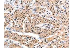 The image on the left is immunohistochemistry of paraffin-embedded Human liver cancer tissue using ABIN7129182(DDX4 Antibody) at dilution 1/20, on the right is treated with fusion protein. (DDX4 antibody)