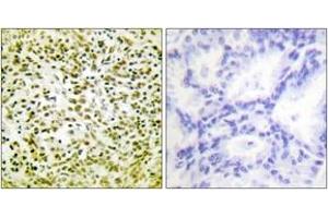 Immunohistochemistry analysis of paraffin-embedded human lung carcinoma tissue, using p53 (Ab-317) Antibody. (p53 antibody  (AA 283-332))