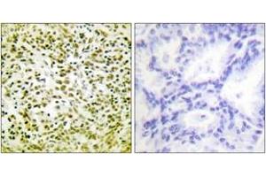 Immunohistochemistry (IHC) image for anti-Tumor Protein P53 (TP53) (AA 283-332) antibody (ABIN1535547)