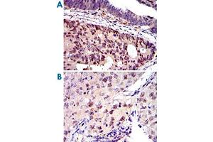 Immunohistochemical analysis of paraffin-embedded human colon cancer (A) and human lung cancer (B) tissues using MCM2 monoclonal antibody, clone 2B3  with DAB staining.